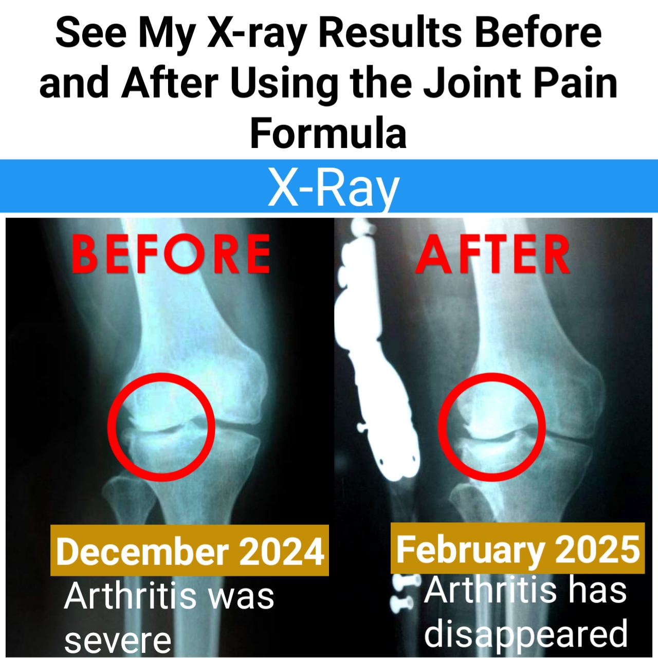 How I Completely got rid of Arthritis